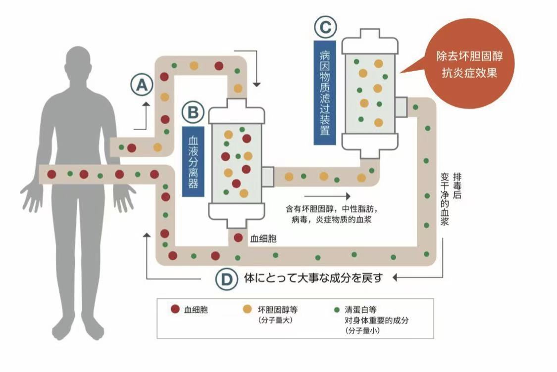 DFPP双重过滤血浆交换疗法.jpg